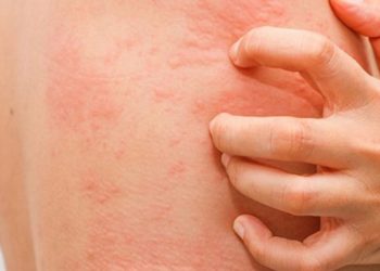 Число случаев растет: вспышка чесотки в Страшенском районе