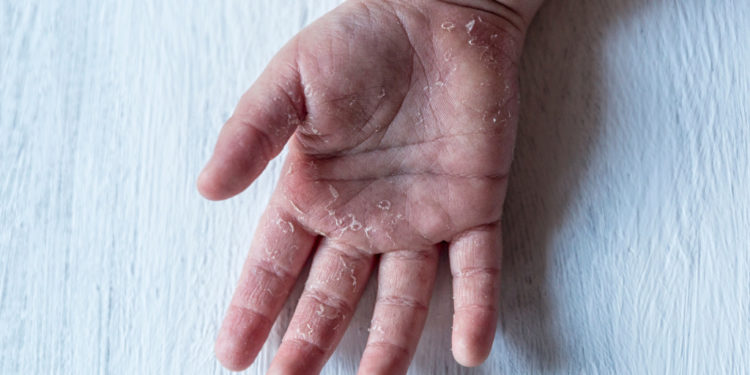 В Гагаузии зафиксировали вспышку скарлатины среди детей