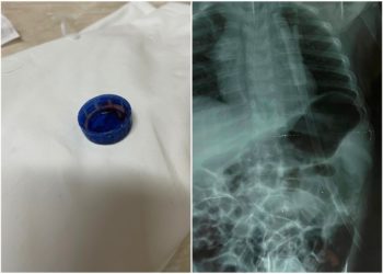 Un copil de 3 ani a ajuns la spital în stare extrem de gravă, după ce a înghițit capacul de la sticlă. Cum se simte micuțul