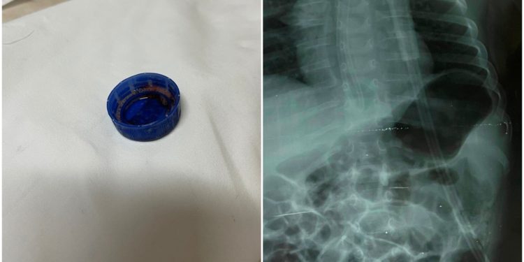 Un copil de 3 ani a ajuns la spital în stare extrem de gravă, după ce a înghițit capacul de la sticlă. Cum se simte micuțul