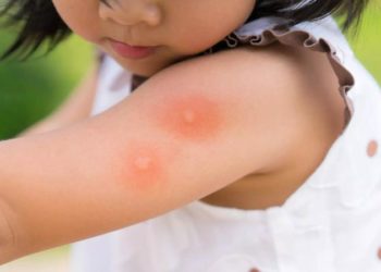 Mușcate de animale sau înțepate de insecte: Peste 500 de persoane au chemat ambulanța, în ultimele două luni. Câte au fost spitalizate