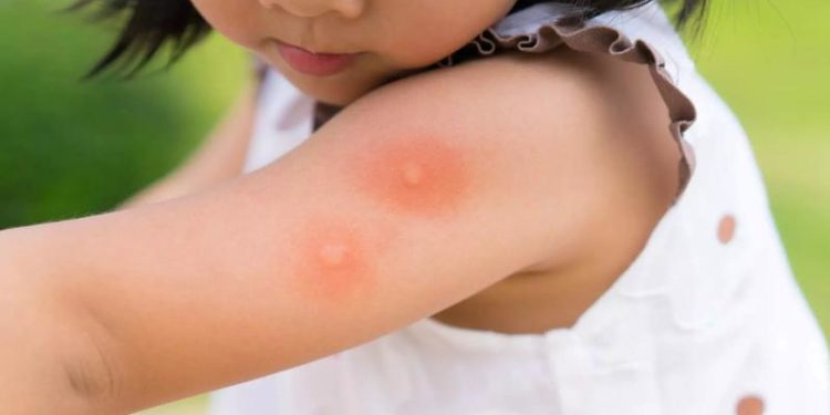 Mușcate de animale sau înțepate de insecte: Peste 500 de persoane au chemat ambulanța, în ultimele două luni. Câte au fost spitalizate